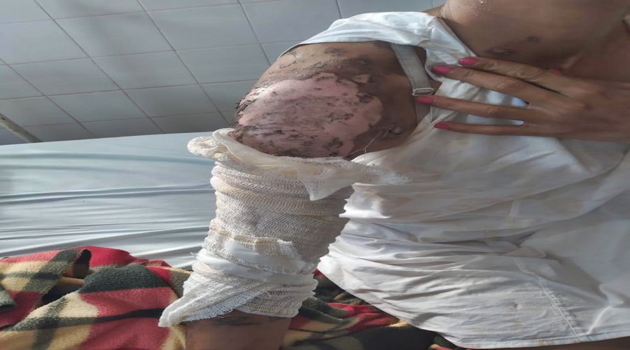 Mulher sofre queimaduras graves após ser jogada em fogueira pela amante do amasio 1