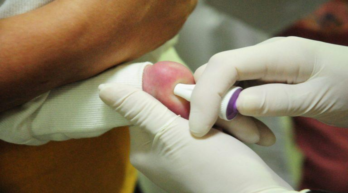 MT Hemocentro atende 599 pacientes com a doença falciforme 1