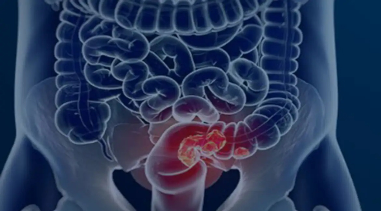 Pacientes com câncer colorretal são diagnosticados em estágio avançado 1