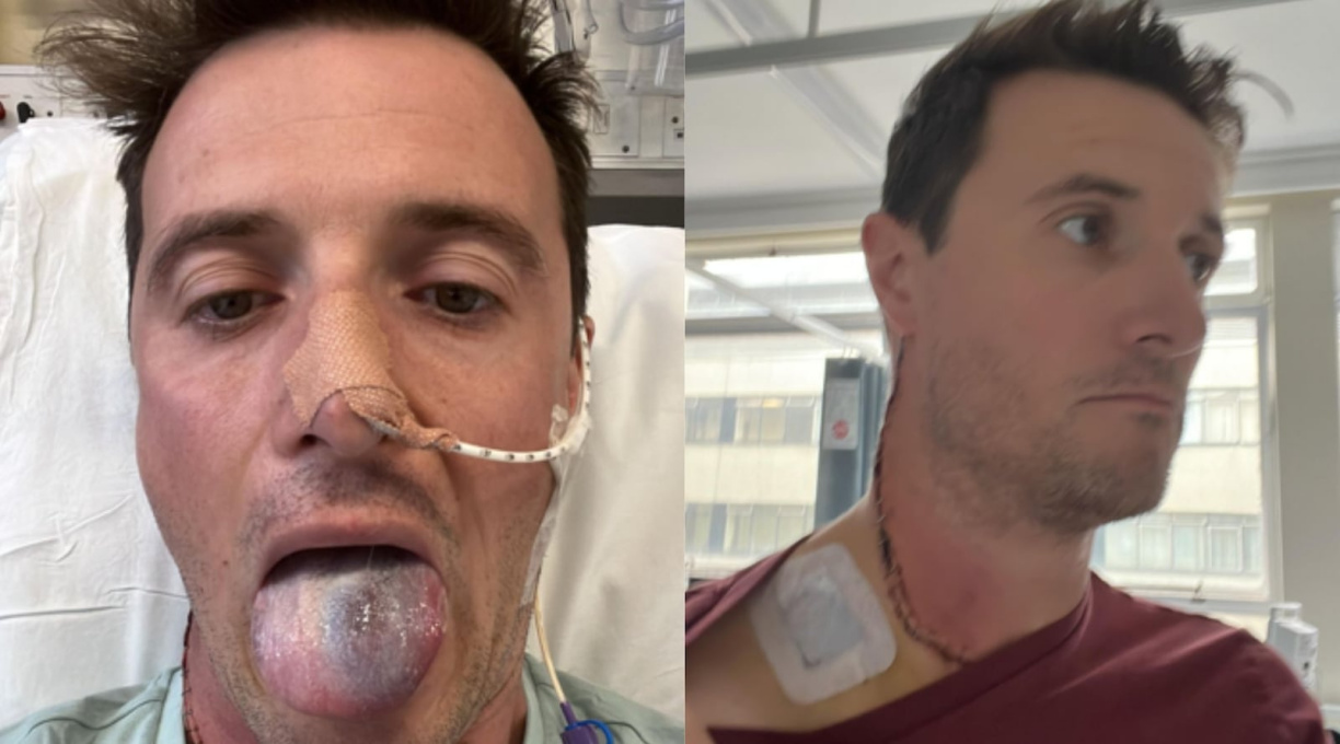 Britânico que teve câncer na língua alerta sobre a importância da vacina contra HPV 1